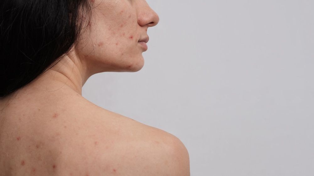 Back Acne Scars Treatment: 3 Steps to Success - The Love Co