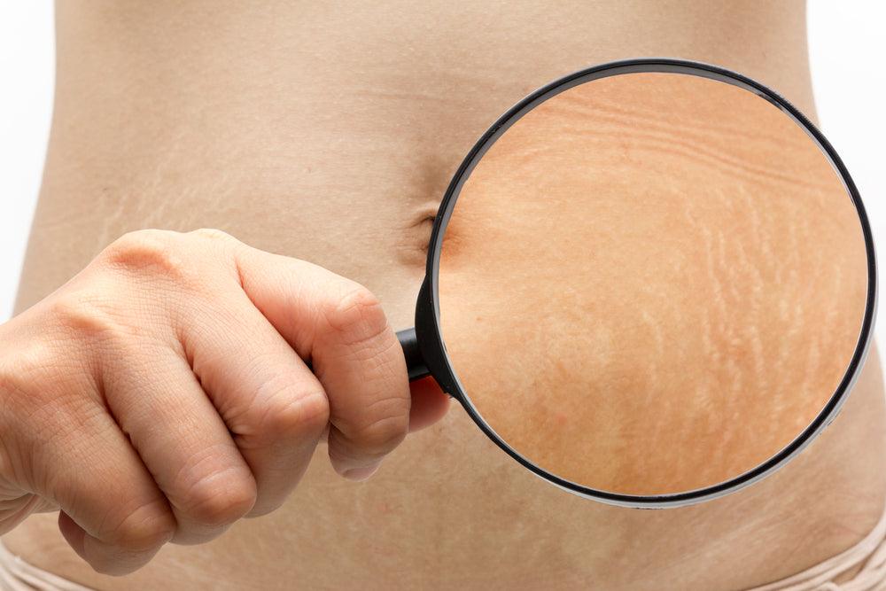 Shea Butter: Say Goodbye to Stretch Marks! - The Love Co