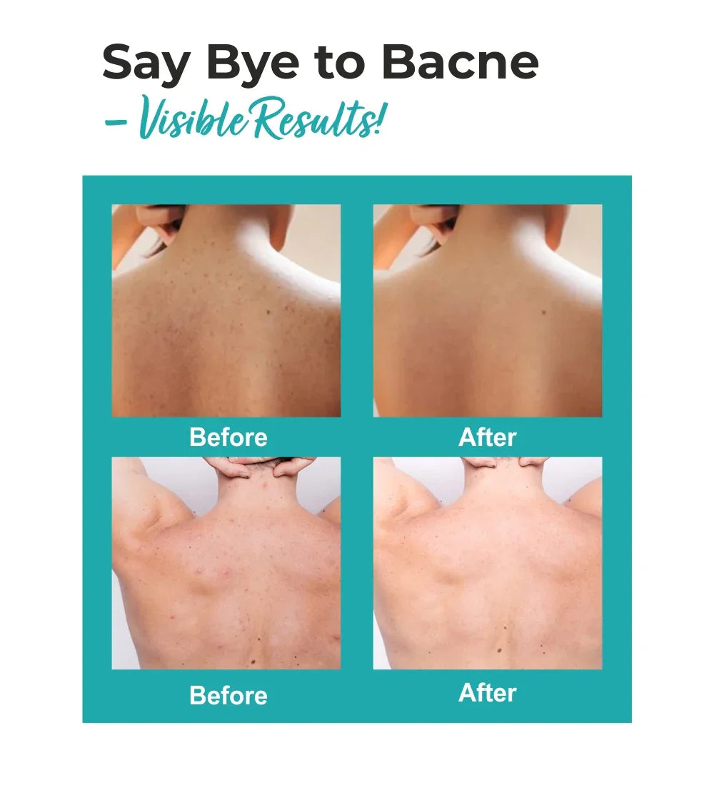 Bacne treatment before and after results on backs, showing clearer skin improvement.