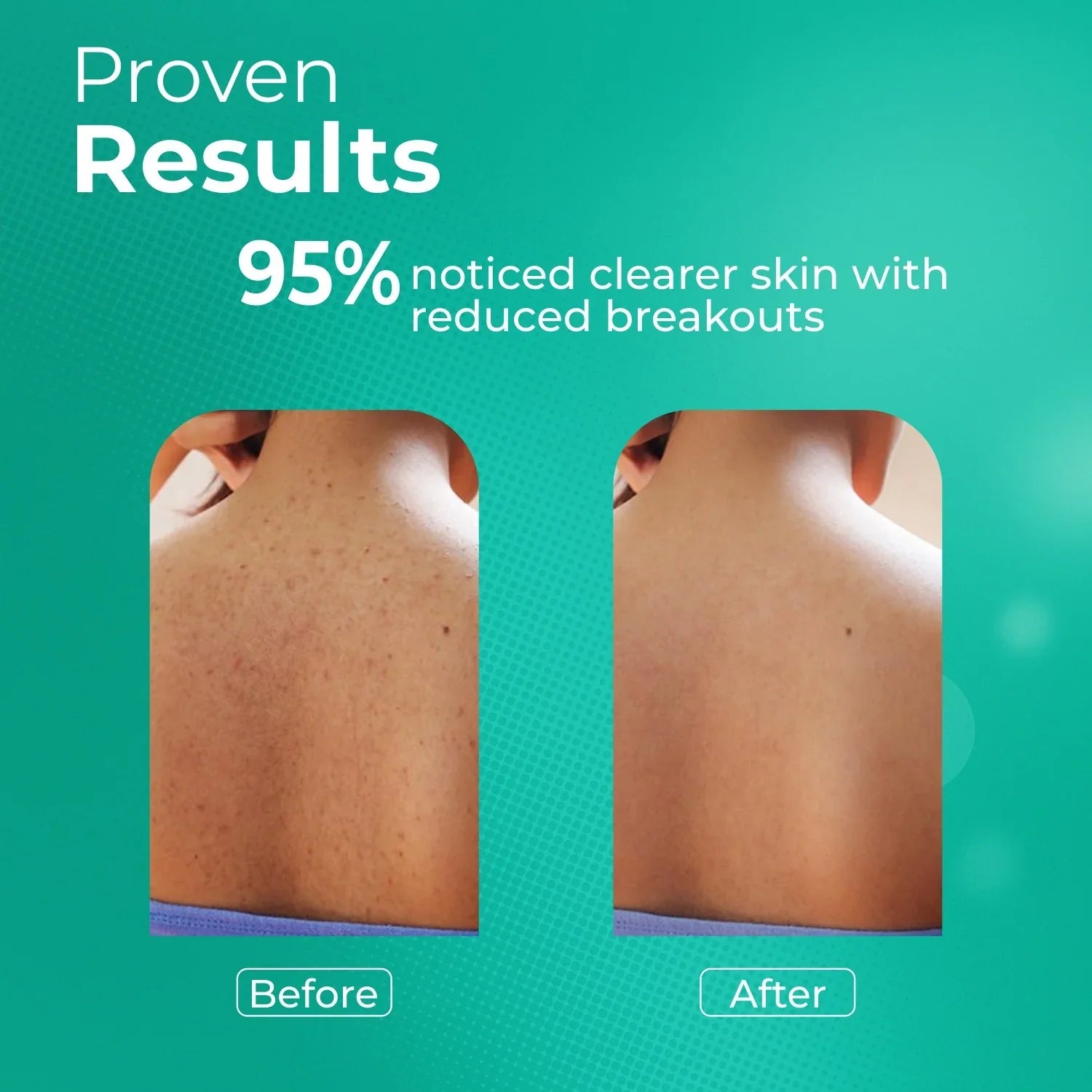 Before and after results showing clearer back skin with reduced breakouts, skincare improvement