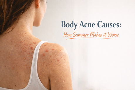 Body Acne Causes: How Summer Makes it Worse