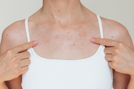 How to Get Rid of Body Acne