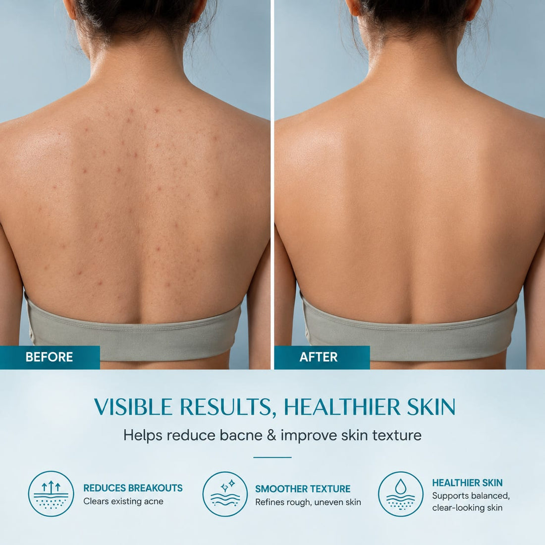 Before and after — back acne cleared with Bacne Warrior
