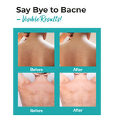 Bacne Warrior Acne-Fighting Body Spray