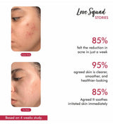 Acne Defence Foaming Face Cleanser - The Love Co