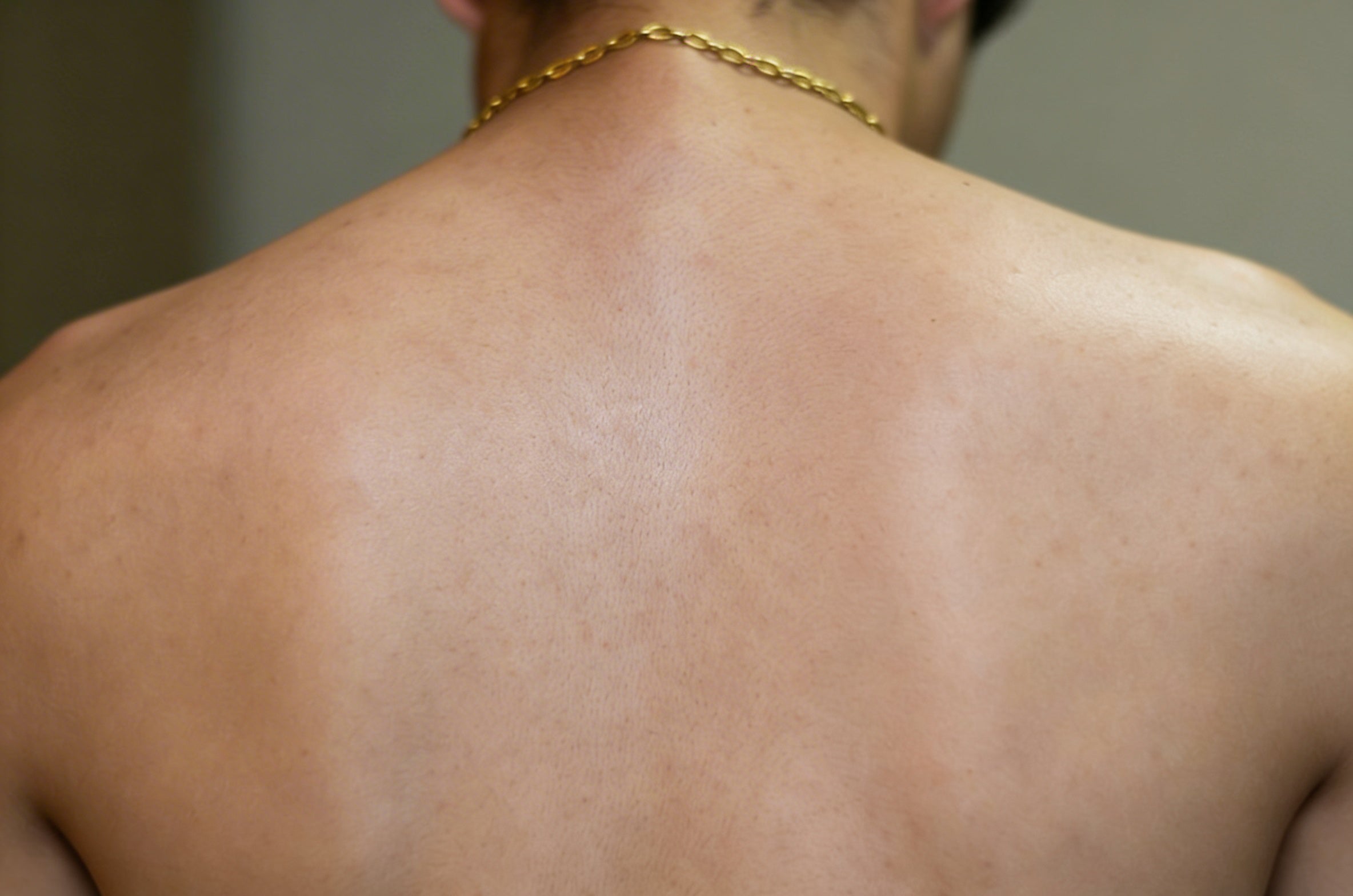 Back of a person after using bacne warrior body spray